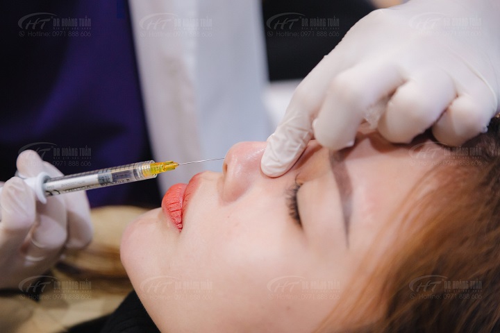 Cận cảnh quá trình tiêm filler mũi